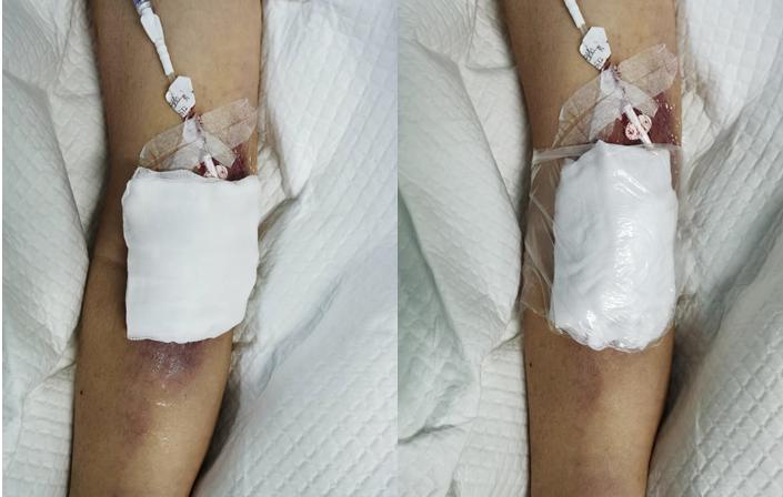 动脉穿刺后发生皮下血肿的原因,动脉穿刺失败怎么预防血肿