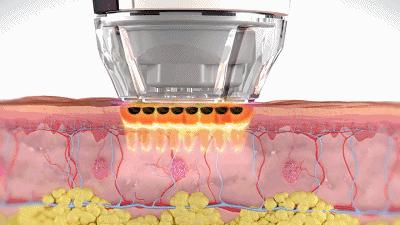 谁来拯救我的激素脸,拯救激素脸问题性皮肤