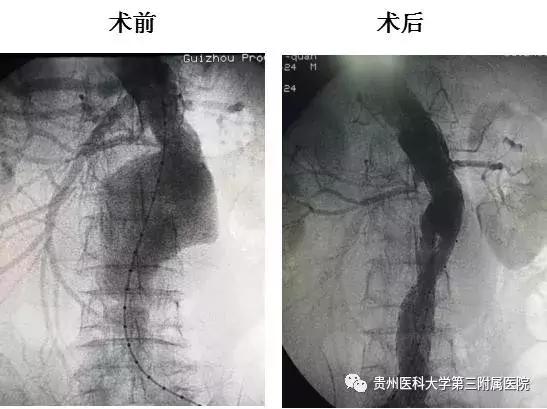 老人血管爆裂会导致死亡吗,88岁老人脑血管爆裂能撑多久