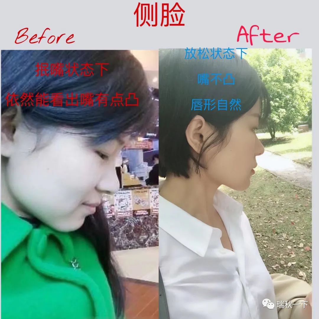 牙齿矫正,你后悔了吗?