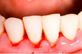 口臭原因和治疗方法刷牙容易出血,早上刷牙出血是什么原因