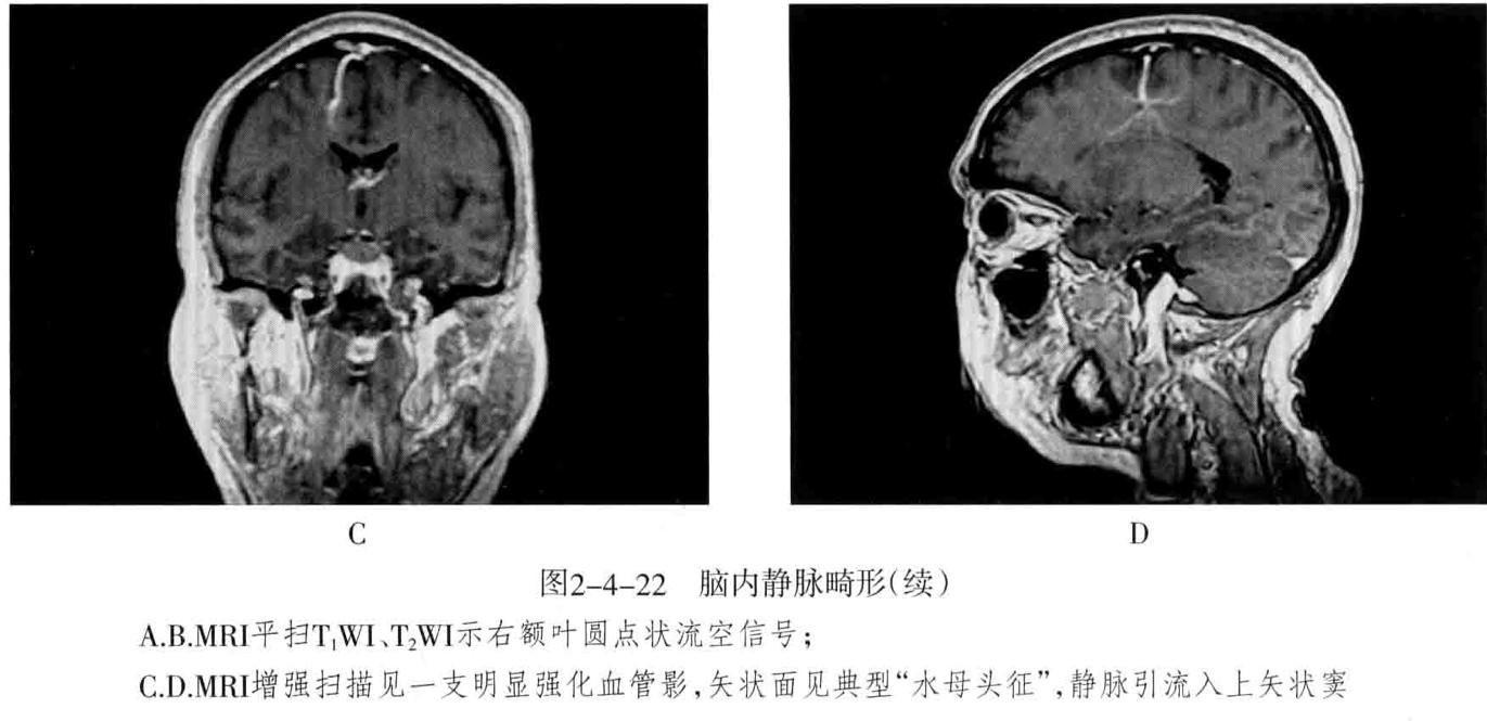 颅内血管轻度狭窄诊断标准,颅内血管先天变异影像