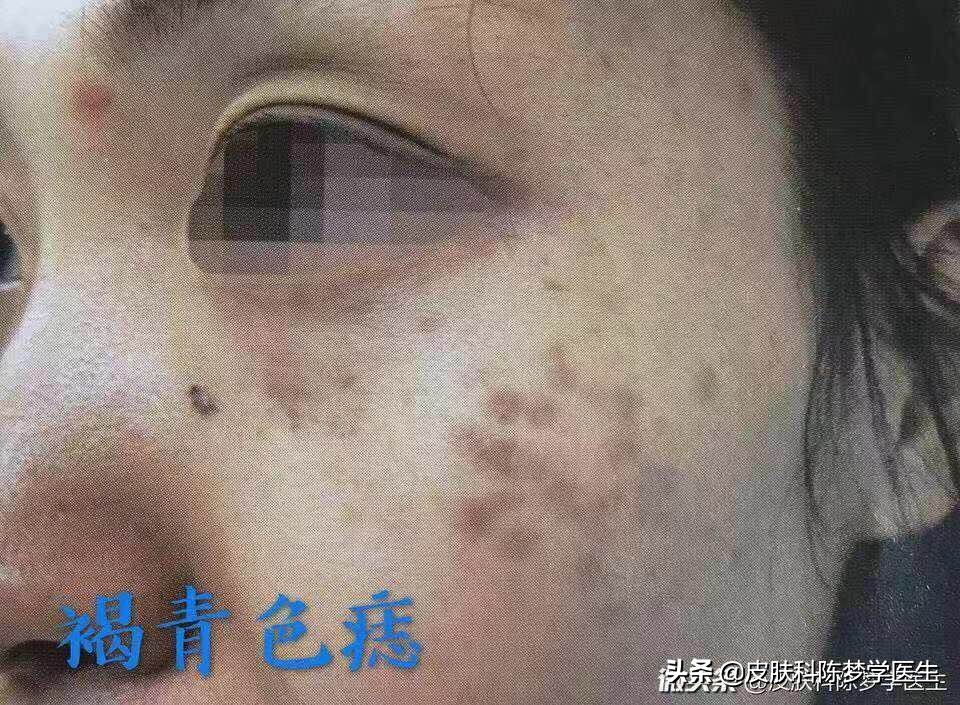 4个治疗面部色斑的方法,25岁脸部色斑怎么治