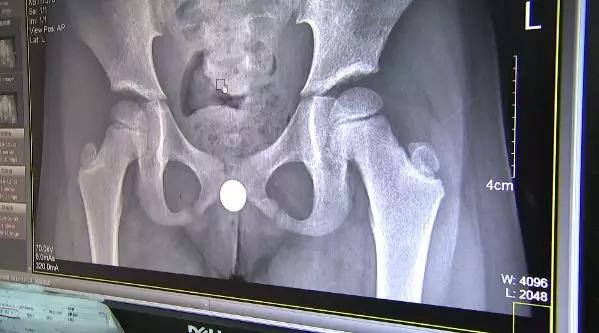 小女孩*体下**塞入异物流血不止！隔了几天走路都不对劲了