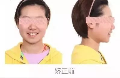 正畸主治学习视频,正畸钟摆效应名词解释