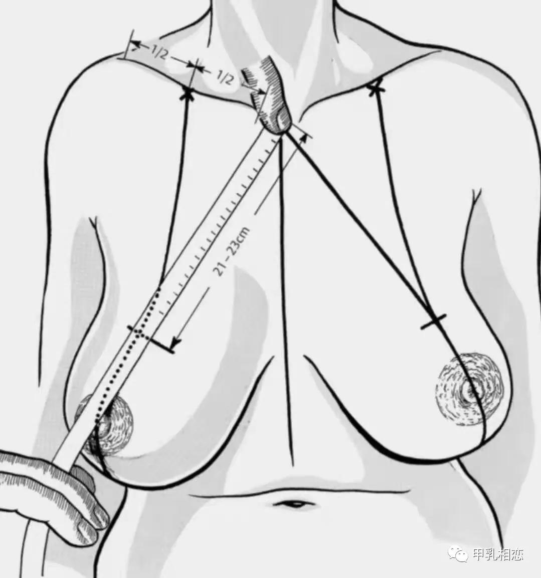 取出假体后胸部是怎样的,胸假体取出后对比图