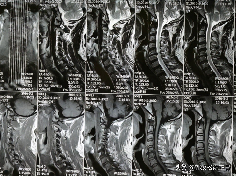 颈椎病引发头晕走路不稳怎么治,颈椎病引起头晕走路不稳怎么办