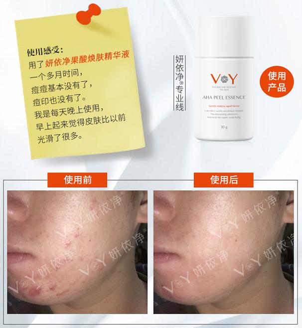 蜂胶果酸焕肤净痘精华液,全家一起用的护肤品