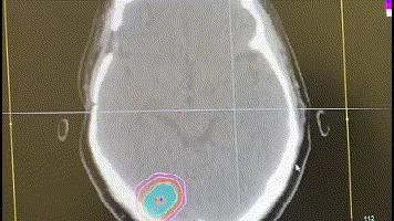河北医大一院射波刀是第几代的,河北医大一院射波刀