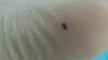 医生不建议激光点痣,点痣医生