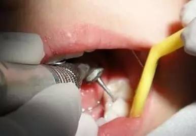 补过的牙能不能洗牙,补过的牙可以洗牙吗