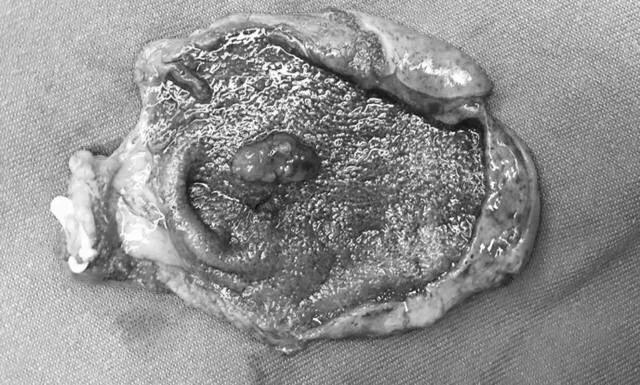 胆囊息肉手术多少钱,发现胆囊息肉怎么办