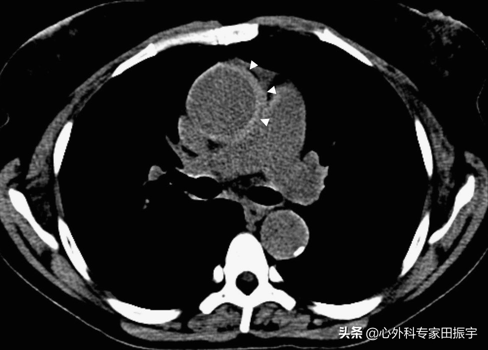 主动脉血肿危险期,高危脑动脉瘤破裂出血