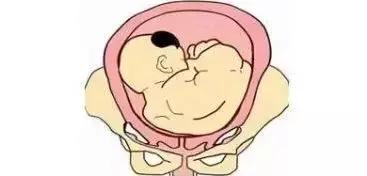 一个动作纠正胎位臀位,什么动作把胎位弄正