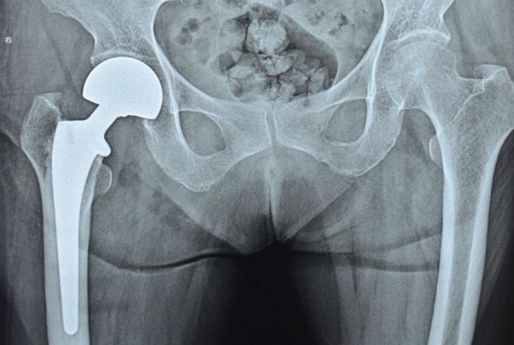 老年人发生股骨颈骨折，专家建议选择西医手术，不建议中医正骨