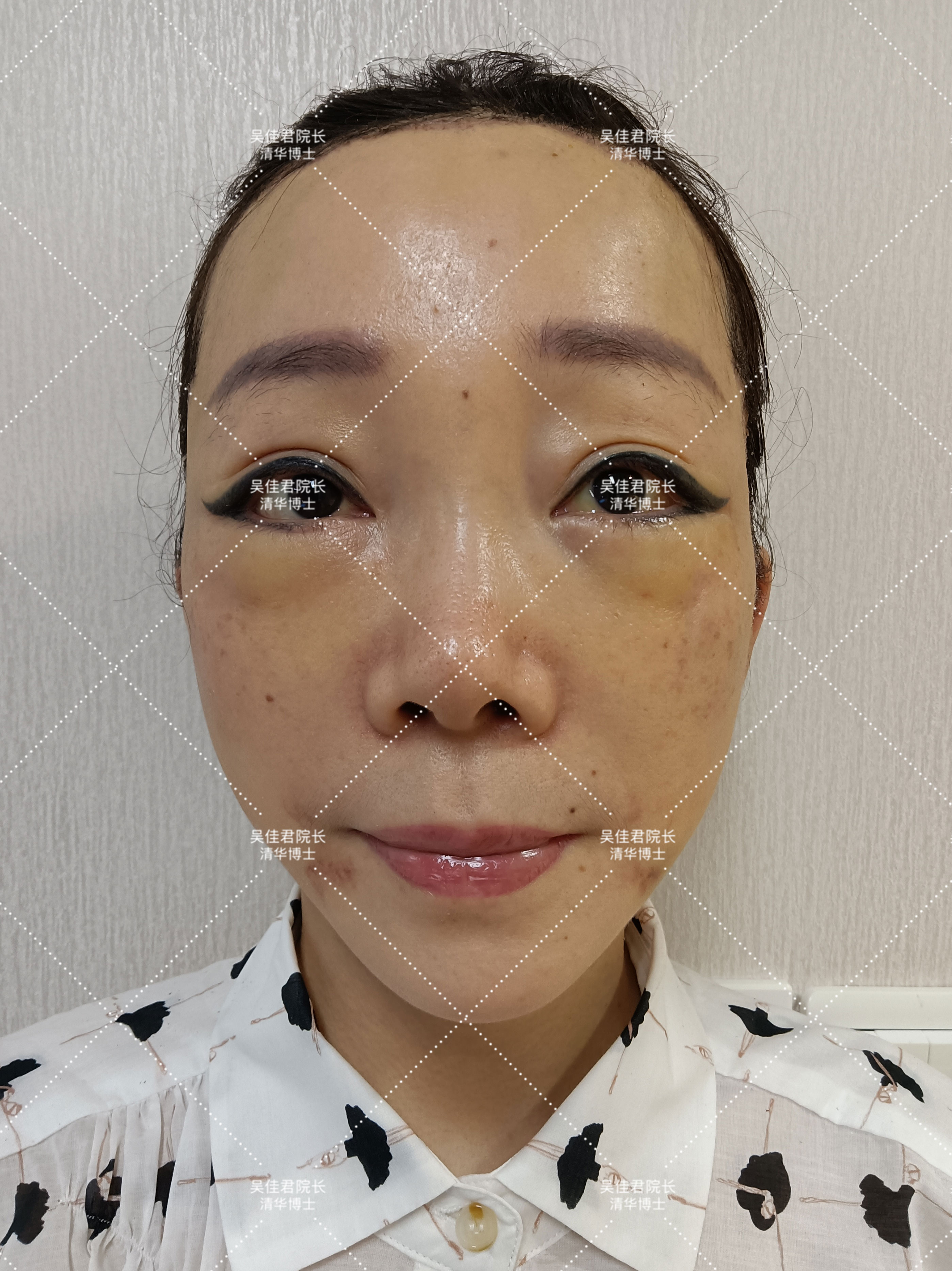 小切口拉皮除皱术适合额头除皱吗,额头缩小大拉皮手术恢复过程