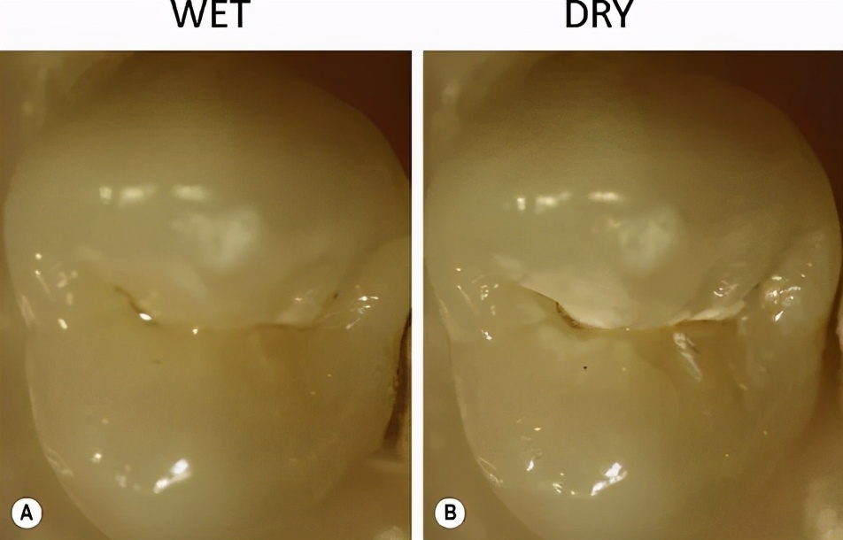 牙齿脱矿了如何补救,牙齿脱矿了怎么治