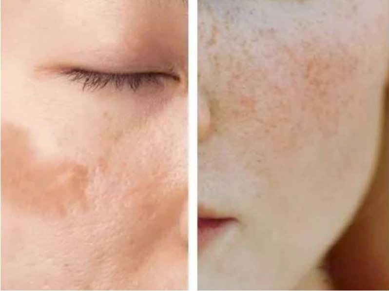 褐斑的原因及治疗方法,褐斑的原因和治疗方法