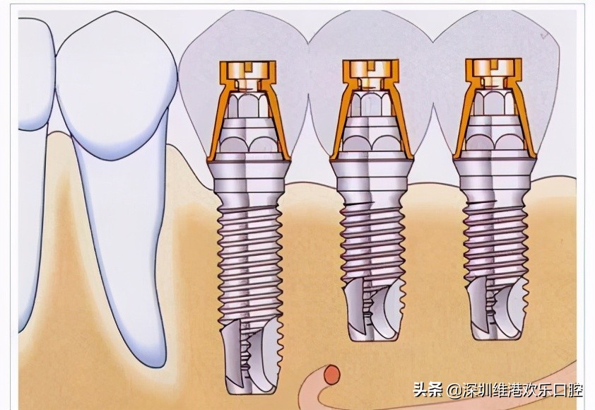 拔牙后为何牙床恢复那么快,拔牙后为啥感觉牙龈外侧塌陷了