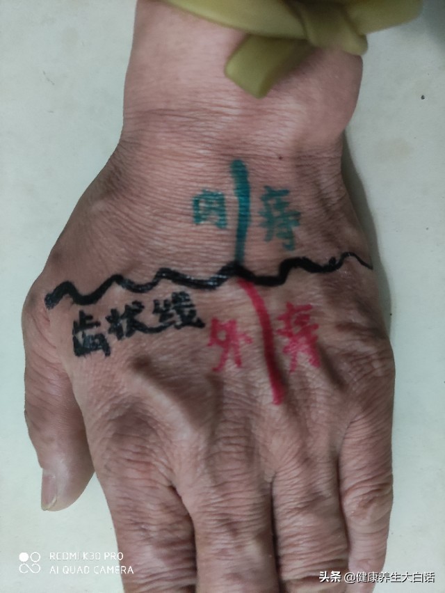 内痔外痔混合痔能做艾灸吗,内痔外痔混合痔的中医治疗方法