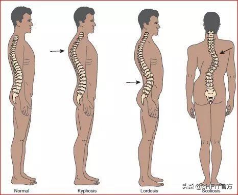 什么？爬行训练能治脊椎病？