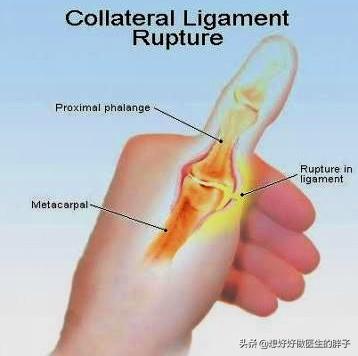 打篮球脚踝扭伤拍片显示没有伤到,打篮球手指挫伤和骨折怎么分辨