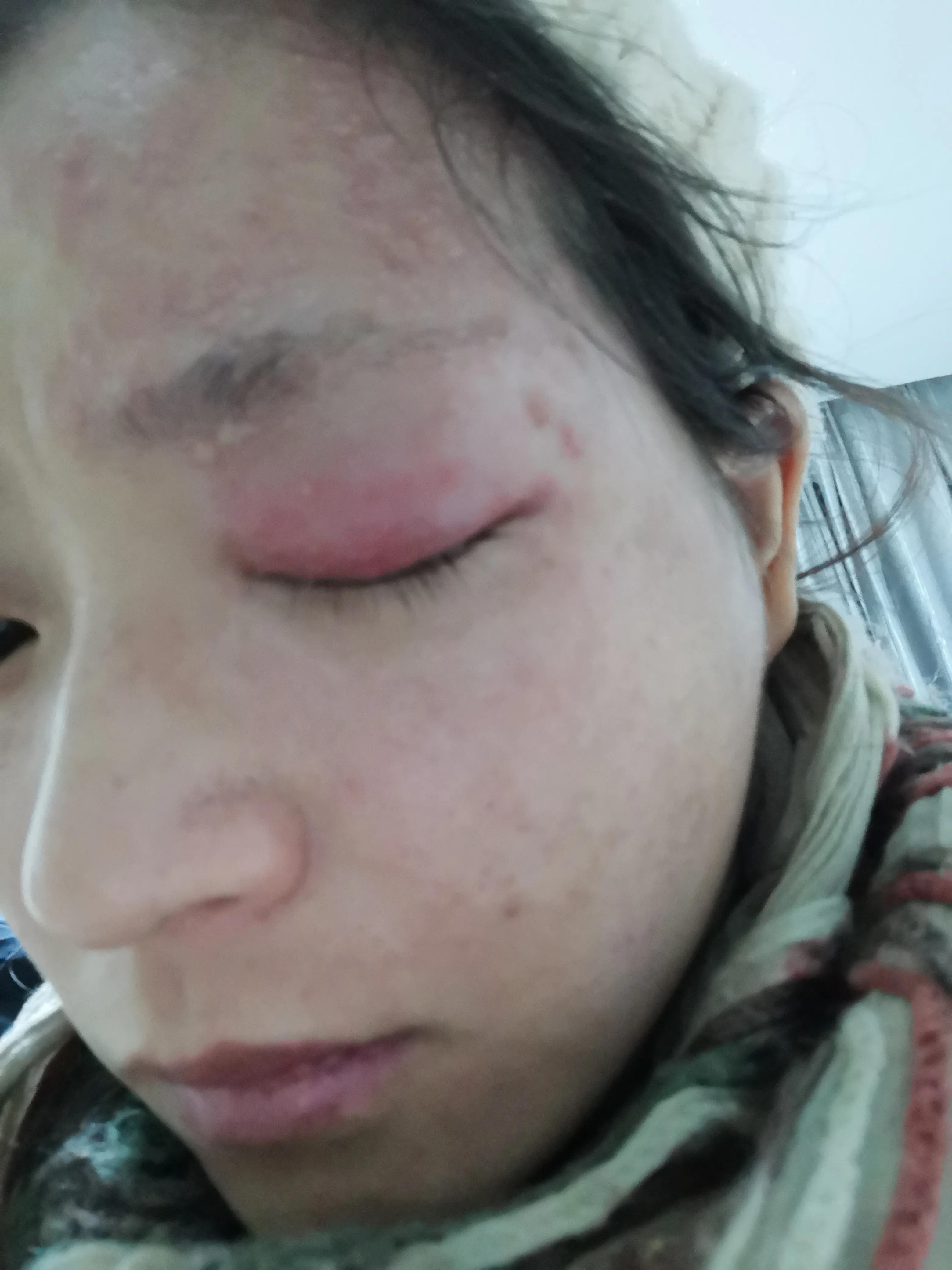 孕妇得了带状疱疹病毒怎么办,孕中期得带状疱疹该怎么办