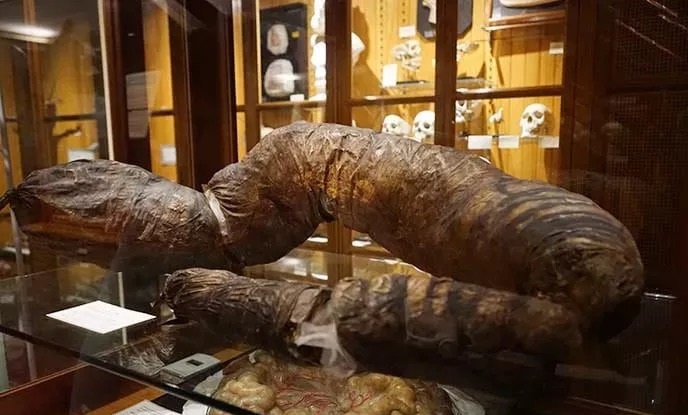 便秘严重拉不出能继续吃饭吗,便秘严重三四天不大便怎么办