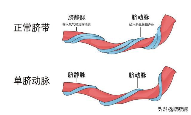 脐带绕颈几周会畸形,脐带扭转和脐带绕颈的区别