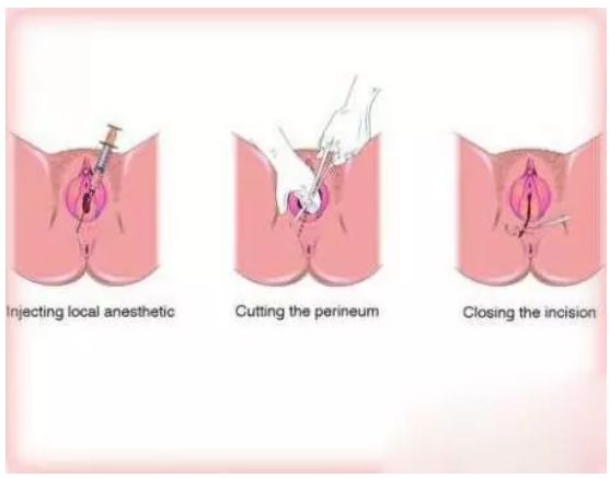 顺产一定要侧切吗?资深产科医生告诉你答案