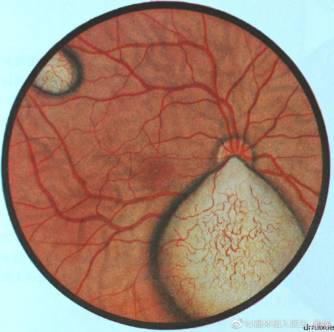 小孩6岁有远视需要治疗吗,儿童眼病的种类和表现症状