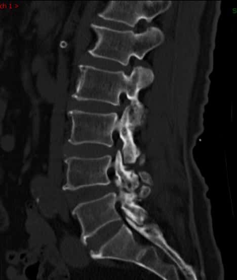 腰椎管狭窄症手术好么,腰椎管狭窄手术和保守治疗哪个好