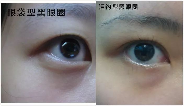 没有熬夜也有黑眼圈怎么办,没有熬夜黑眼圈怎么去除