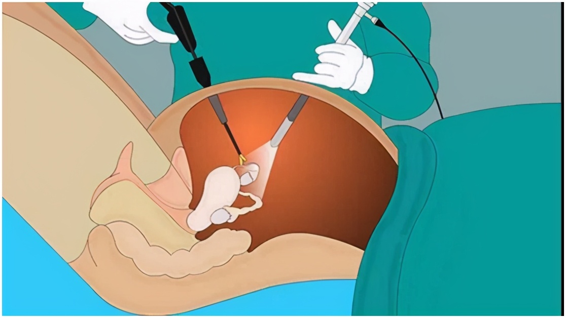 卵巢畸胎瘤是什么,畸胎瘤这个病严重吗