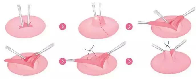 乳头内陷如何进行日常护理,乳头内陷是遗传问题还是发育问题