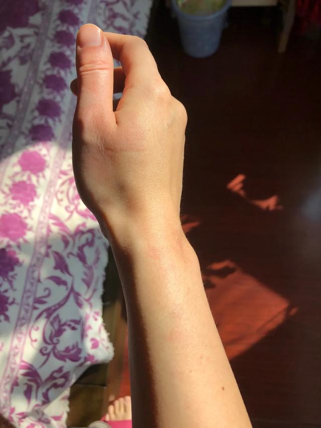 疫情期间低温烫伤的水泡怎么处理,烫伤后二十二天基本都平了