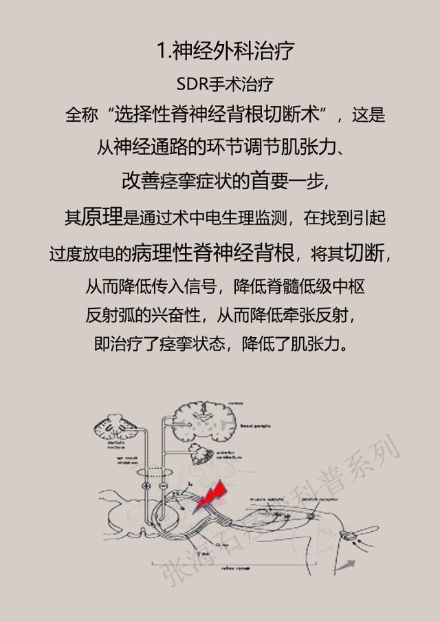 眼睑痉挛如何治疗,痉挛状态如何缓解