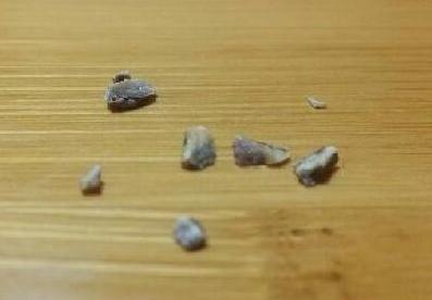 牙齿里很臭的小颗粒,牙齿里黄黄的东西闻起来特别臭