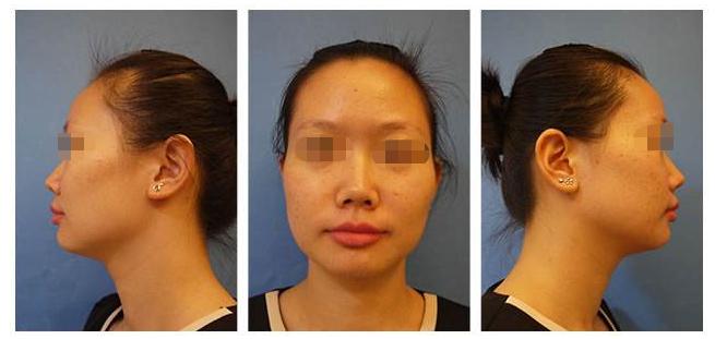 塌鼻子蒜头鼻瘦下来能好看吗,塌鼻梁蒜头鼻侧脸为什么会很丑