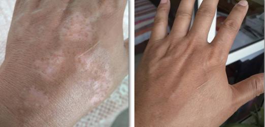 白癜风拉锯战最后结局,白癜风开始治愈图