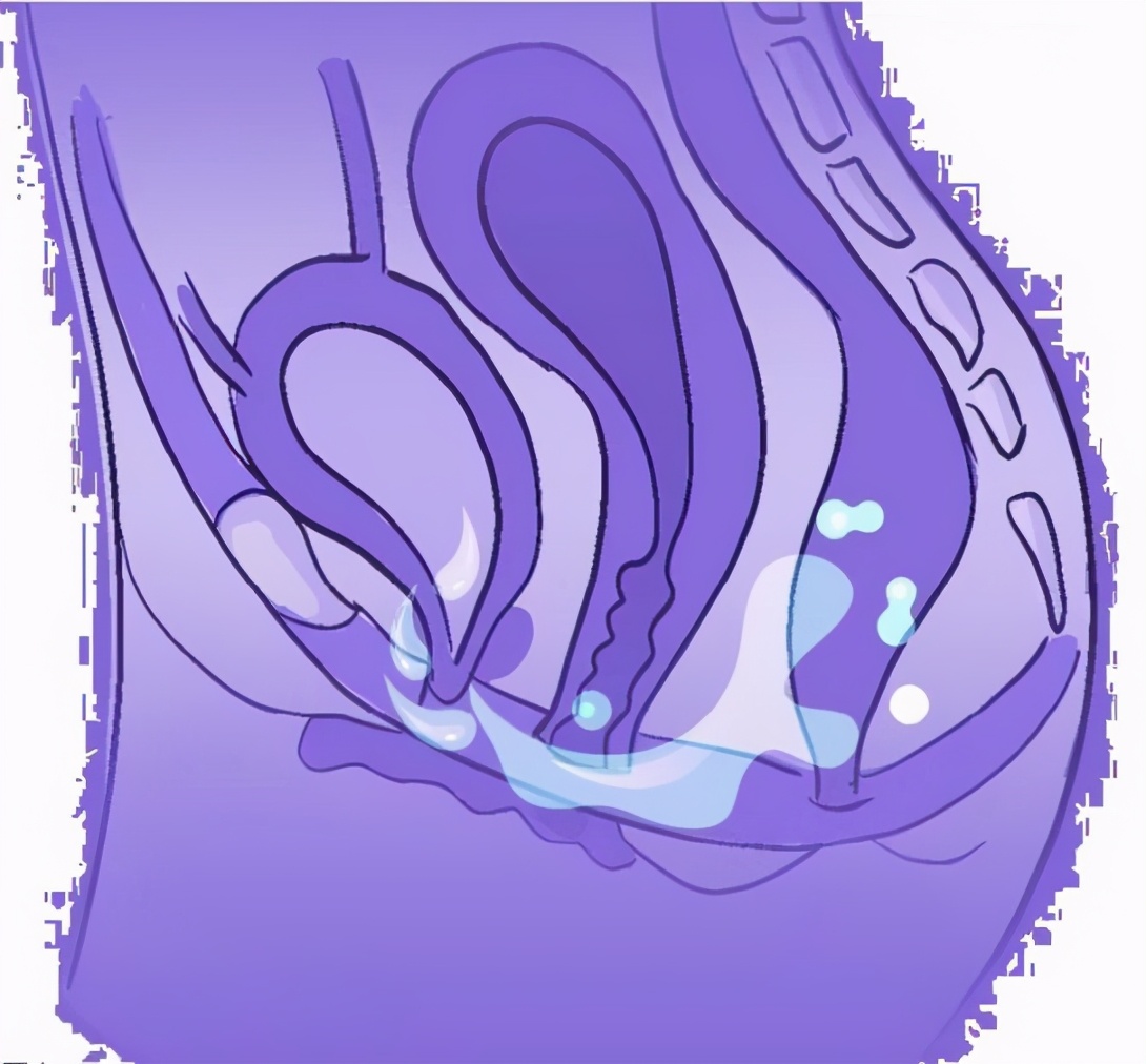 有盆腔积液就是盆腔炎吗,有盆腔积液就是盆腔炎么