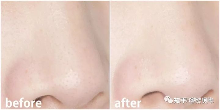 公认最好用的去黑头神器,网红推荐去黑头神器