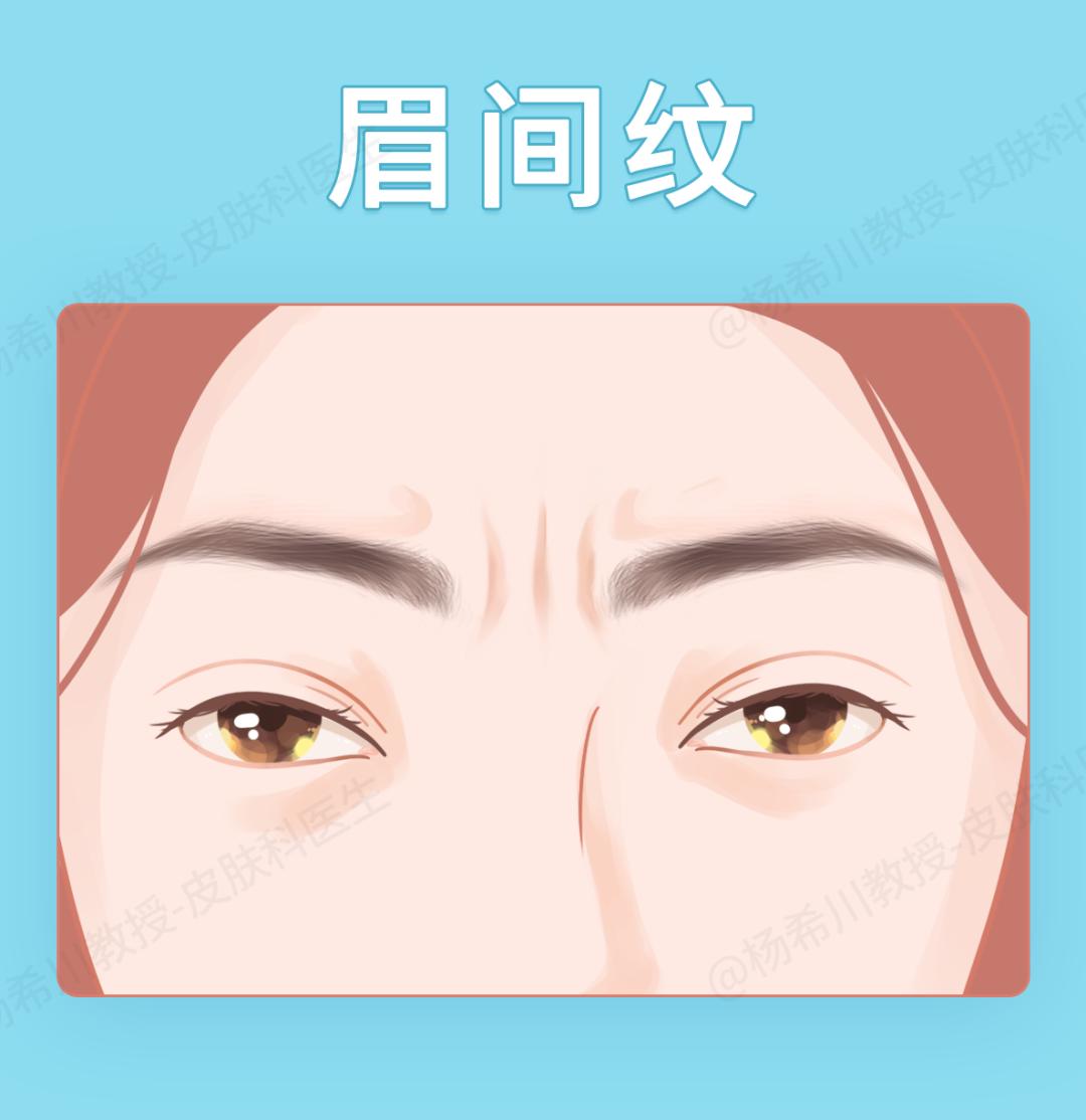 打除皱针没效果是什么原因,打除皱针不成功案例