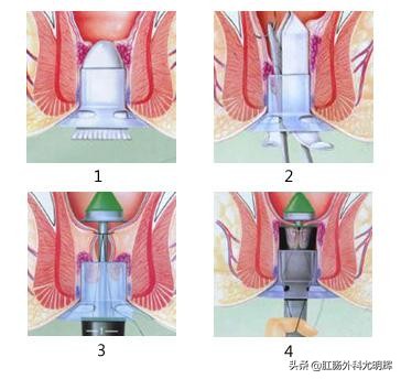 痔疮手术tst与pph哪个好,rph和pph痔疮手术哪个好