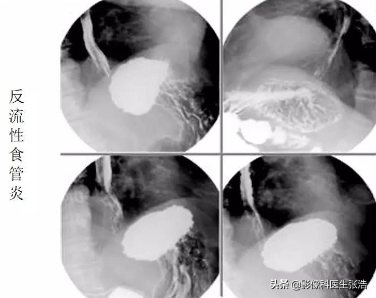 胃钡餐能看到食道问题吗,食道有问题钡餐能查出来吗