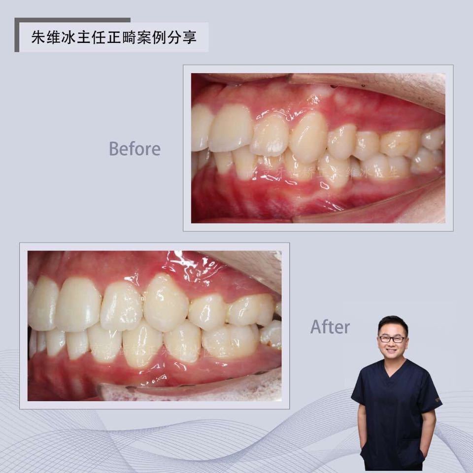 南京正畸朱维冰怎么样,南京牙齿正畸矫正技术