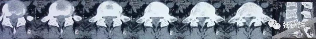 巨大腰间盘突出可以保守治疗吗,腰椎间盘突出不治疗越来越严重