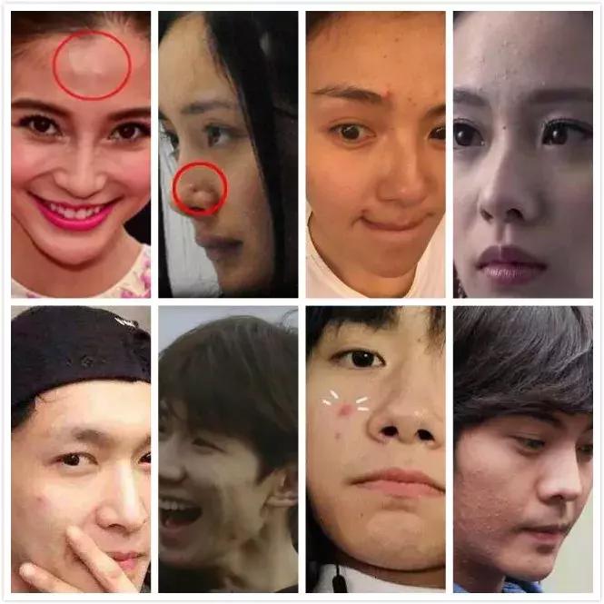 痘肌调理真实案例,痘肌10年了怎么修复