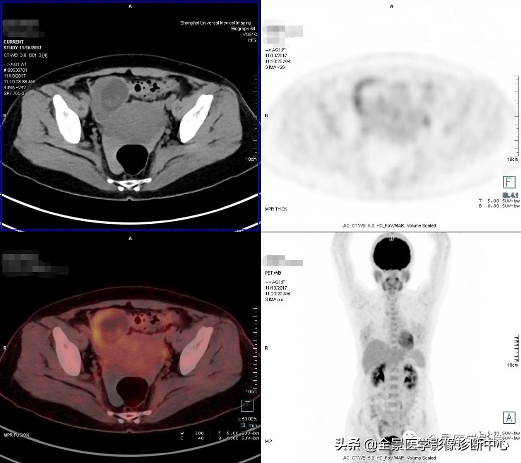 “宫外孕”生死时速8小时