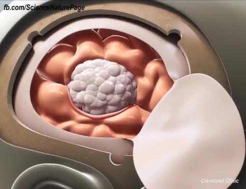 三甲医院治疗肿瘤曝光,脑部肿瘤的最佳治疗方法